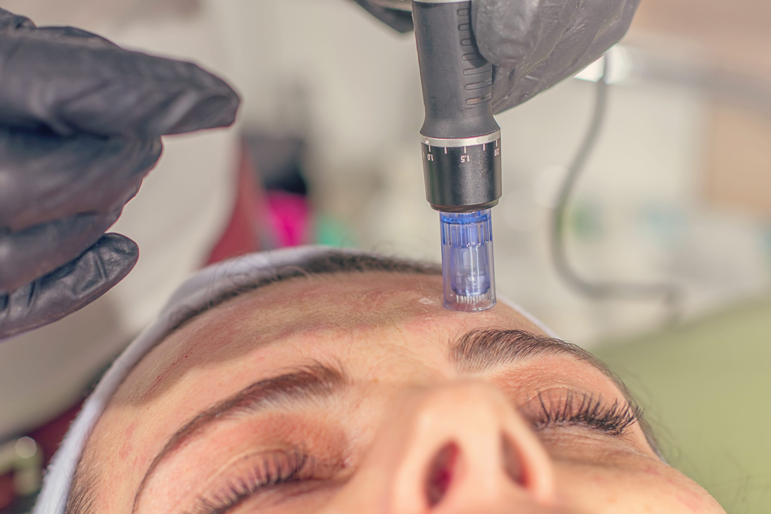 Chemical Peels &<br />
Micro-Needling